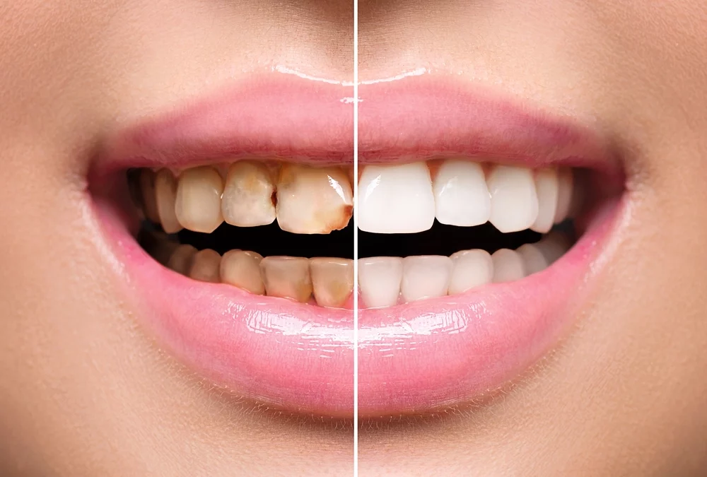 Restauration d’une partie de la dent : Inlay - Onlay - Overlay