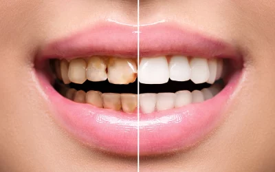Restauration d’une partie de la dent : Inlay – Onlay – Overlay