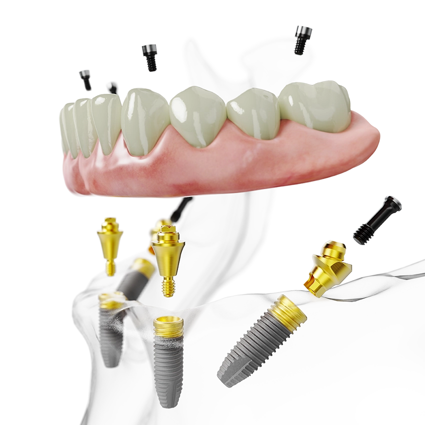 Implants guadeloupe - cabinet dentaire le Papillon