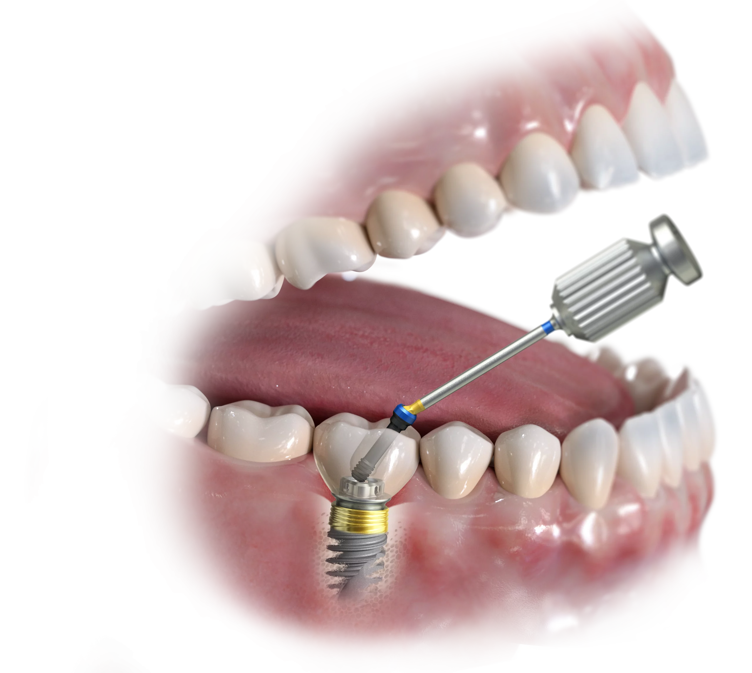 Implants dentaires-processus-cabinet dentaire le Papillon