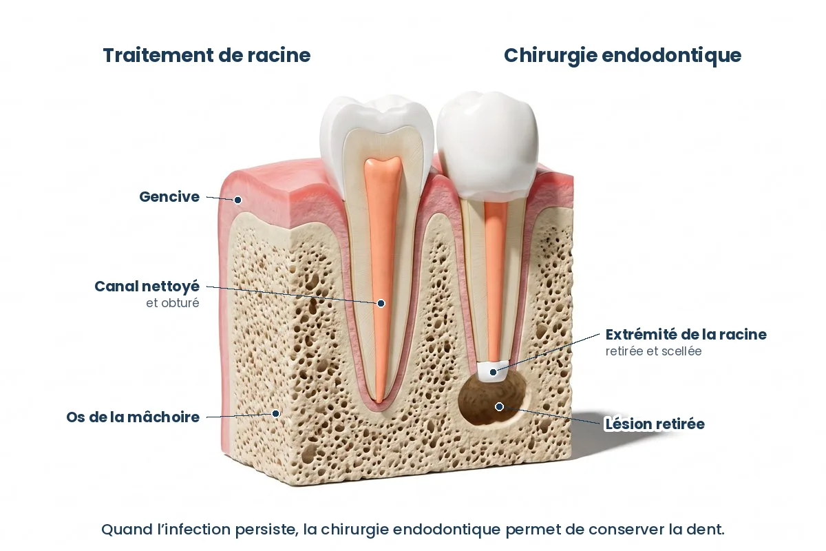 Schéma d’un traitement endodontique