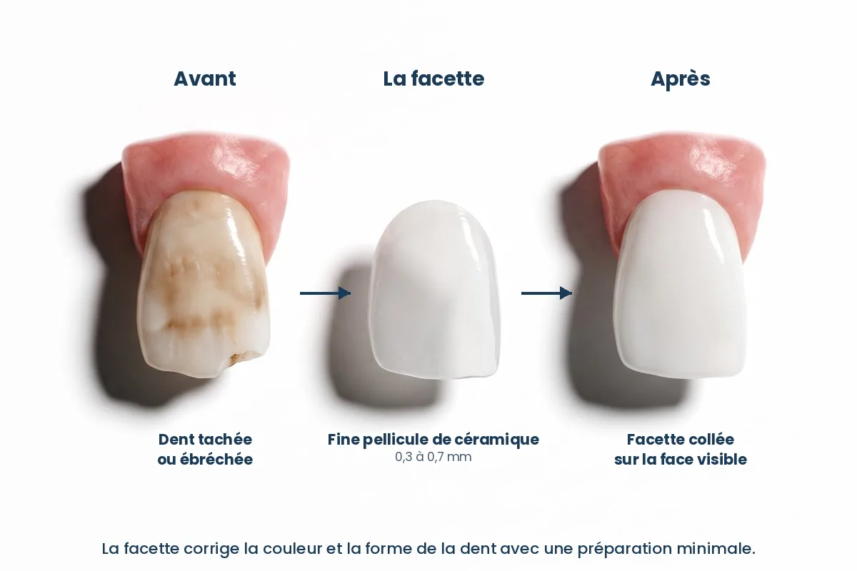 Schéma de la pose d’une facette dentaire