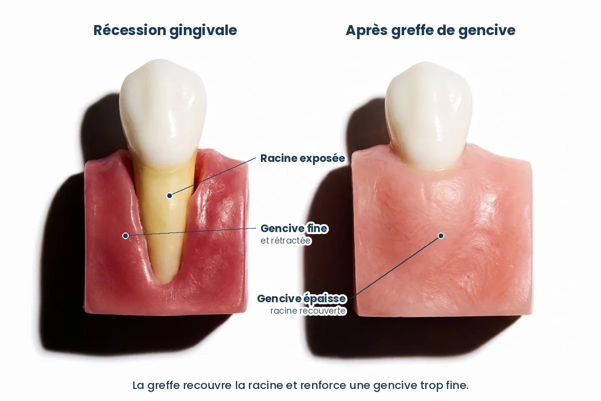 Schéma d’une greffe de gencive
