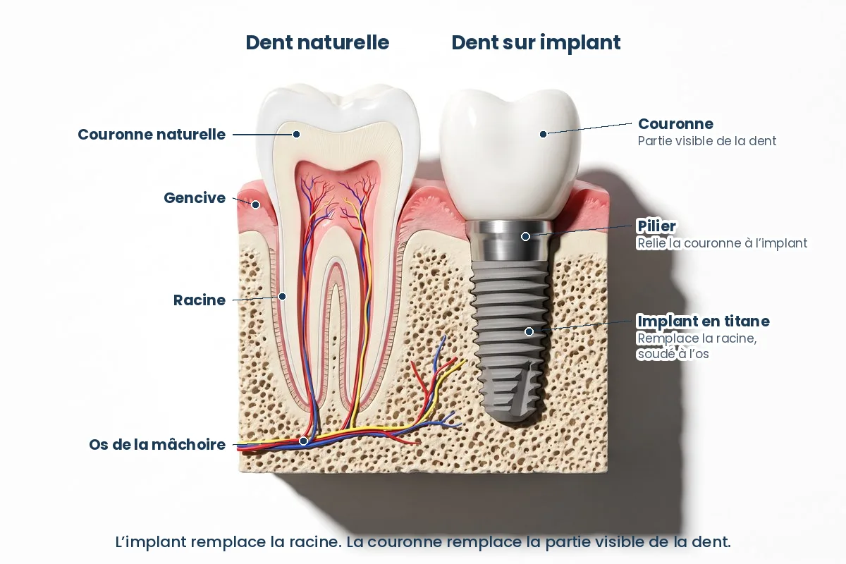 Schéma d’un implant dentaire