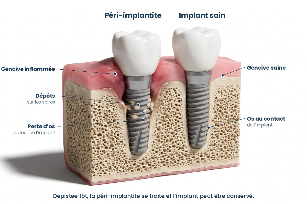 Schéma d’un implant atteint de péri-implantite