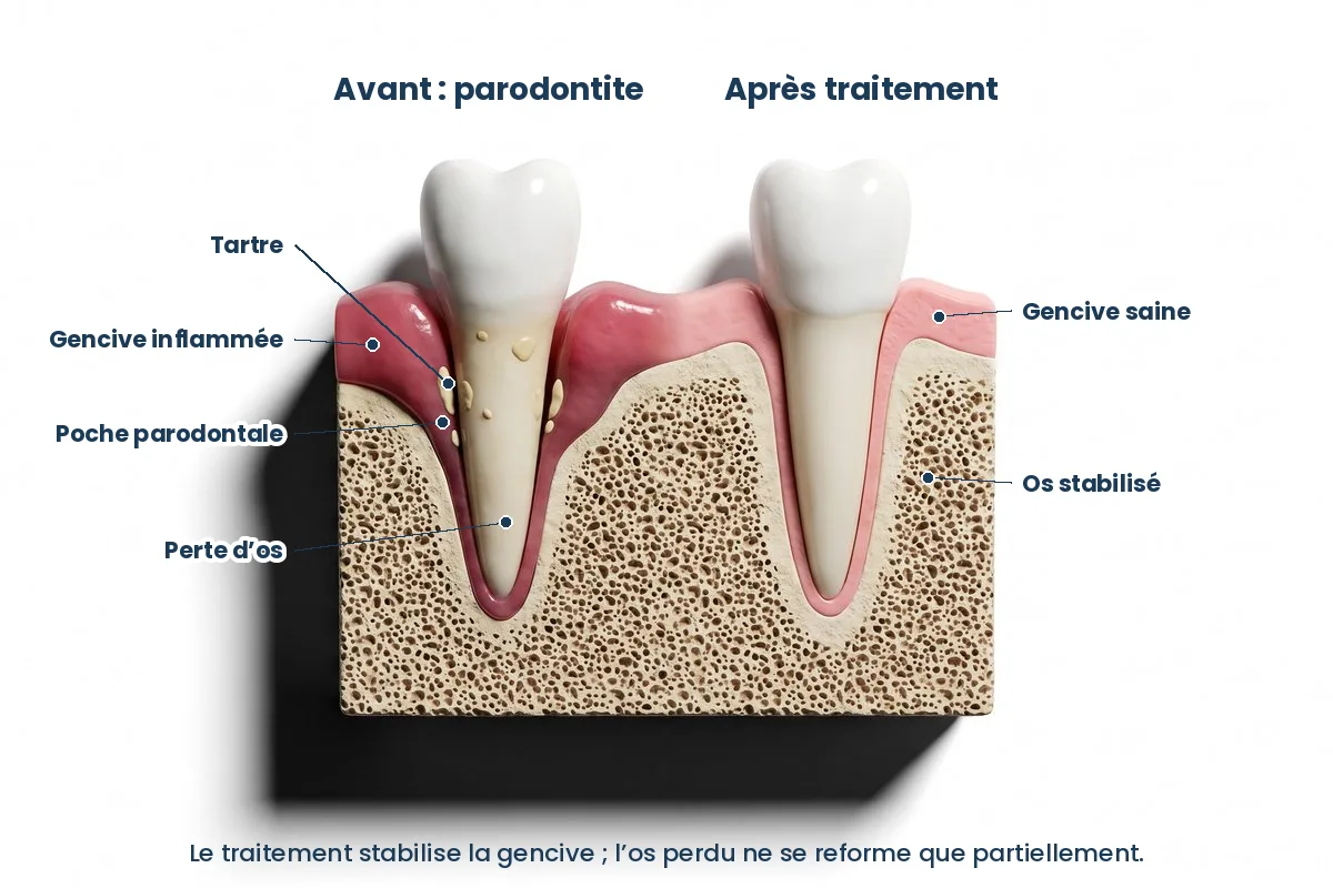 Schéma d’une poche parodontale