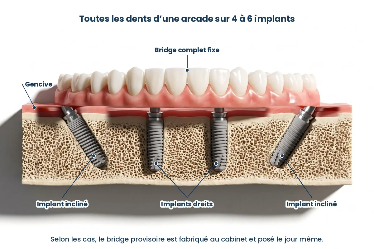 Schéma d’un bridge complet fixe sur implants
