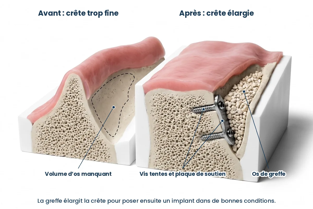 Schéma d’une greffe osseuse d’apposition : crête élargie par vis tentes, plaque de soutien et os de greffe